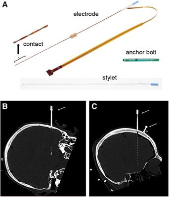 Implantation accuracy of novel polyimide stereotactic electroencephalographic depth electrodes—a human cadaveric study